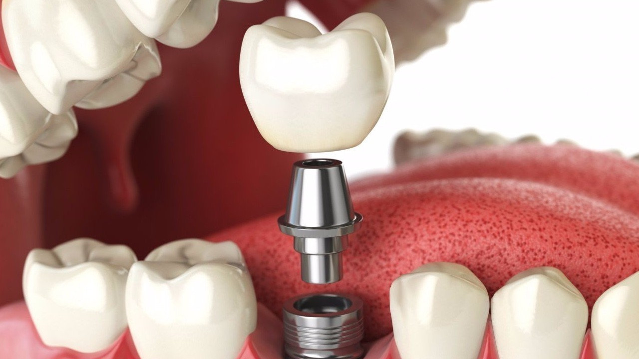Что собой представляет зубная имплантация, её особенности