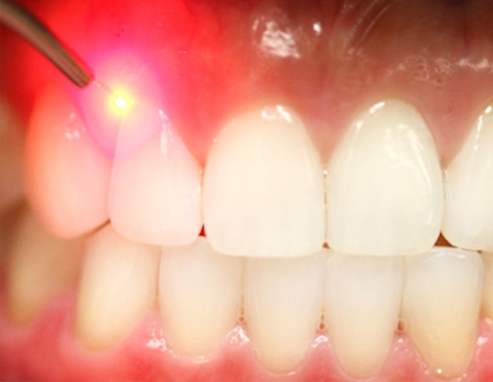 Зубы можно будет лечить безболезненно