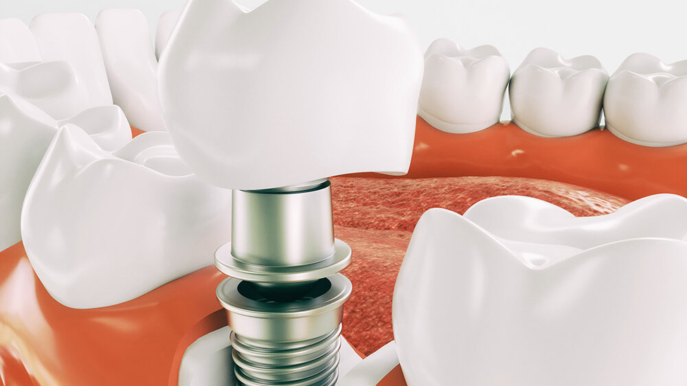 Факты в пользу имплантации зубов
