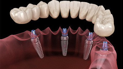 Зубы за один день: инновационные технологии в стоматологии