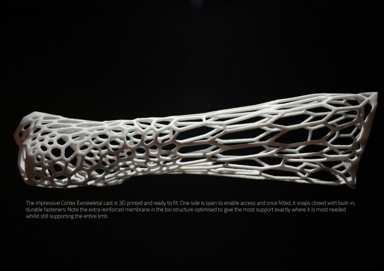 3D-печатная концепция Cortex избавит от зуда при заживлении переломов