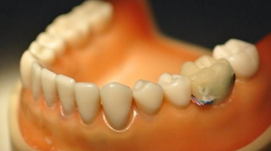 Ученые разработали зуб с Bluetooth