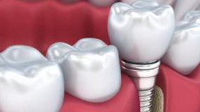 Имплантация как инновационный метод восстановления зубного ряда