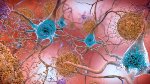 Исследование Йельского университета раскрывает потенциальную причину болезни Альцгеймера