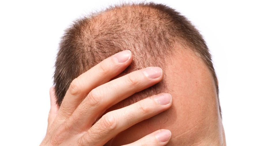 Исследование гормона стресса помогает в лечении выпадения волос